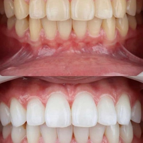 Clareamento Dental