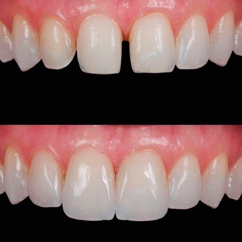 Diastema