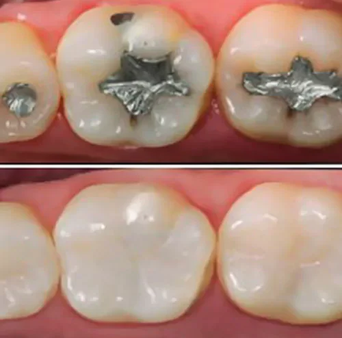 Restauração Dentária